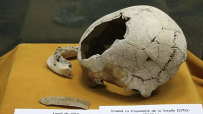 Operație pe creier în Transilvania acum 5000 de ani